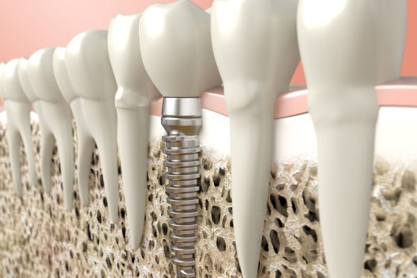 expertos en implantologia en Bilbao Cido Dental